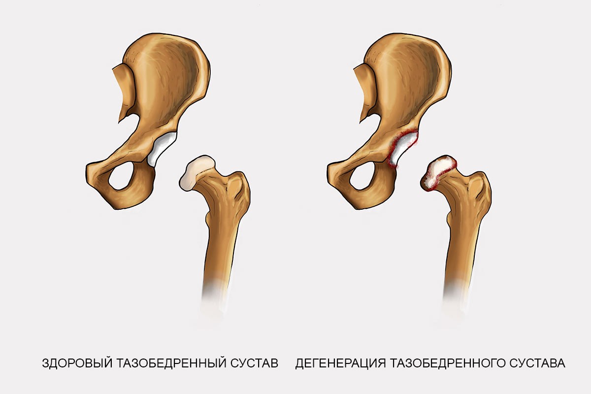 Головка кости скользит в суставной впадине благодаря. Коксартроз тазобедренного сустава. Тазобедренный сустав. Форма головки бедренной кости. Дегенерация тазобедренного сустава.